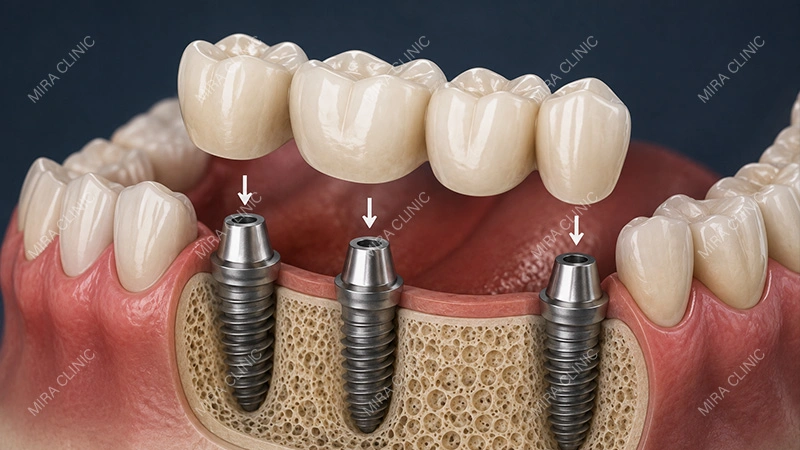 Implant-supported bridge